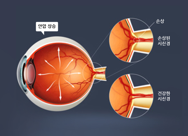 당뇨망막병증