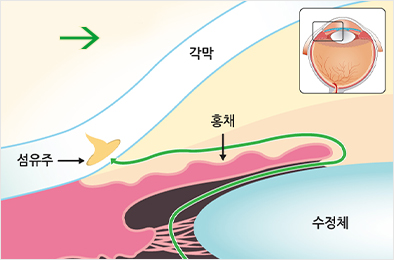 개방각 녹내장