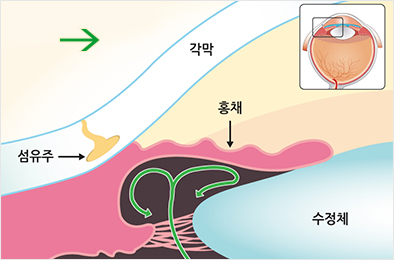 폐쇄각 녹내장