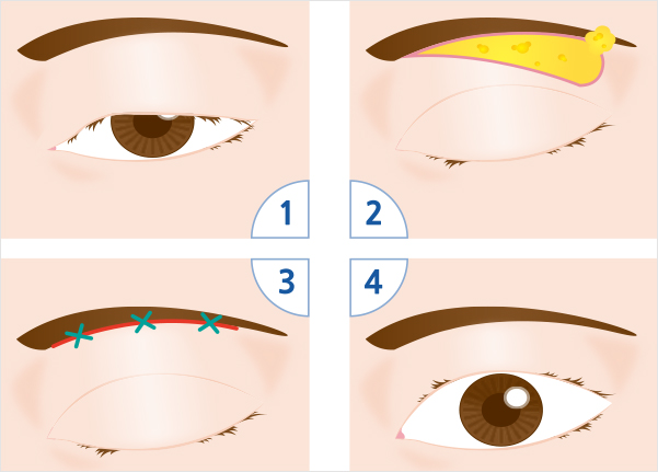 눈썹하 상안검 성형술 이미지