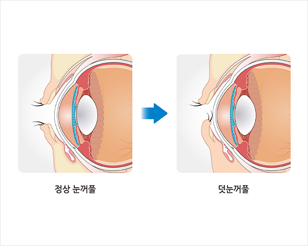 덧눈꺼풀 이미지