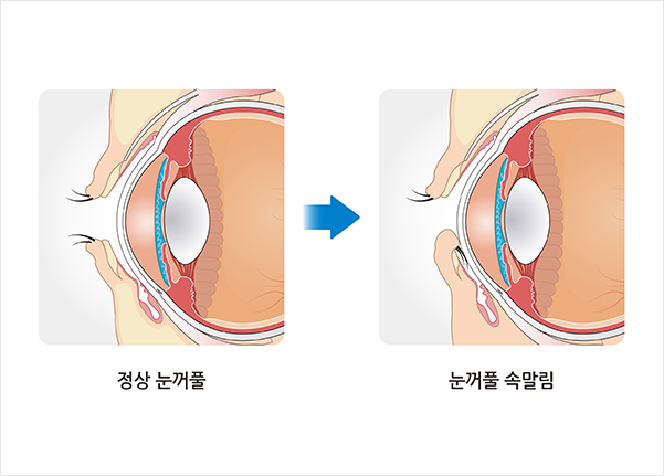 속눈썹 속말림 이미지