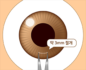 수술과정2