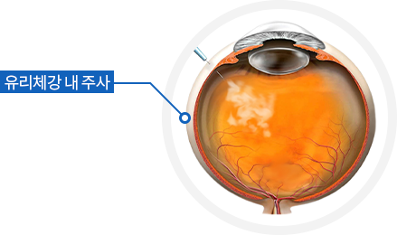 유리체강 내 주사