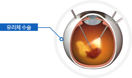 유리체 수술