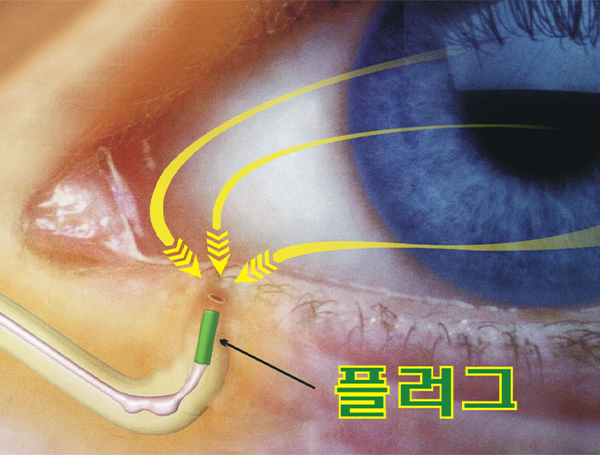 누점폐쇄술 이미지